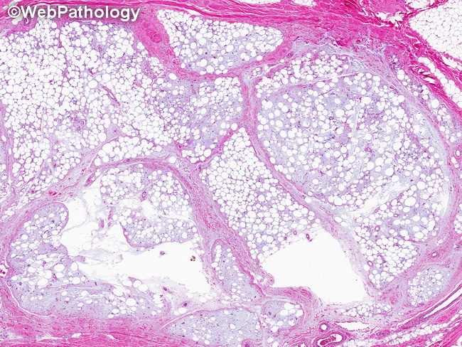 Soft Tissue_Lipomatous_Lipoblastoma25_resized.jpg